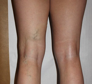 My legs prior to the application of NanoVein
