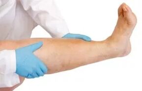Lower limb swelling
