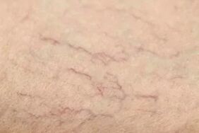 Vascular stars