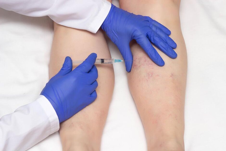 Sclerotherapy is a method of treating varicose veins.