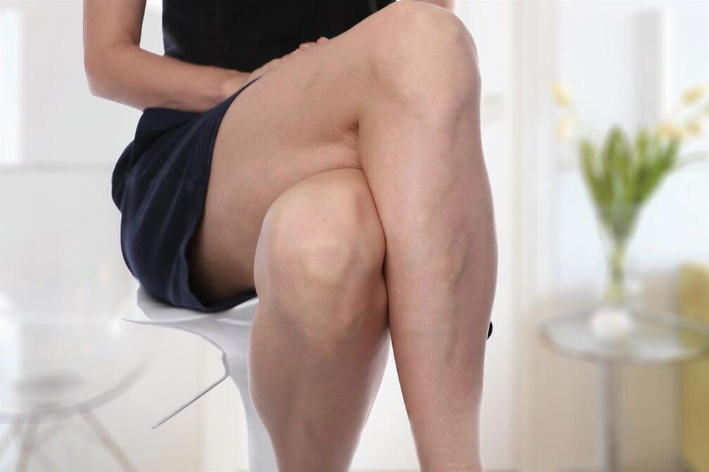 Varicose veins in a woman.