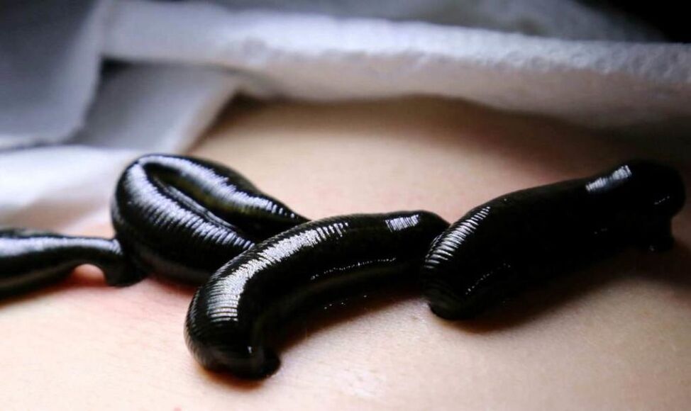 Treatment of varicose veins with leeches.