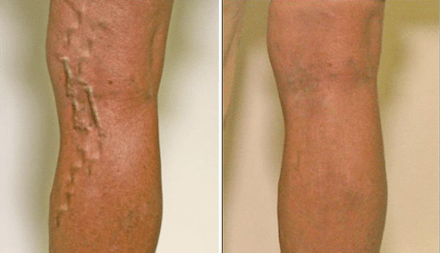 varicose veins in stages 1 and 3 of development