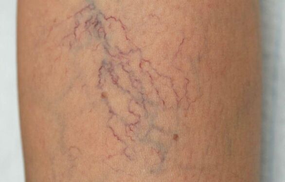 varicose veins in the legs in women