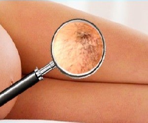treating varicose veins with home remedies