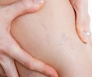 treatment methods for varicose veins