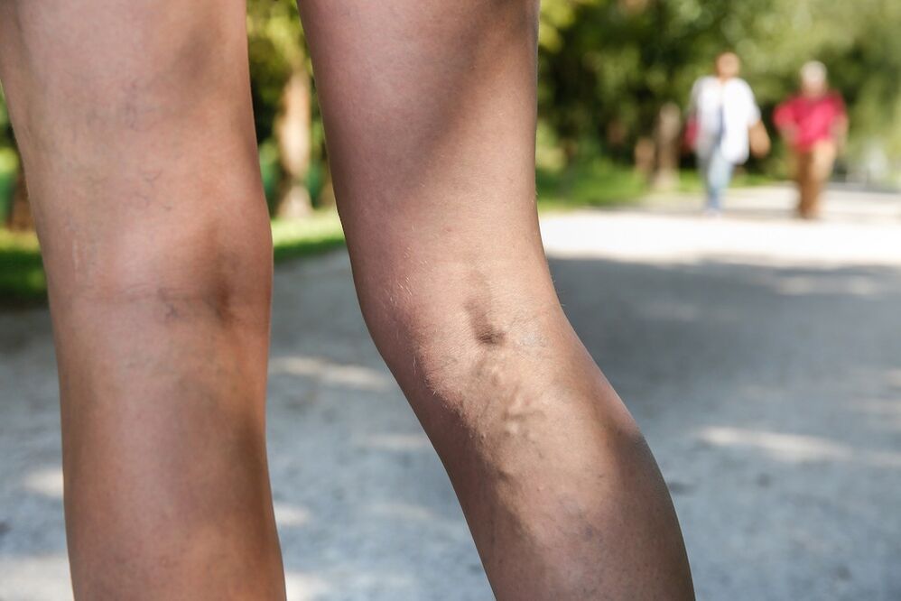 varicose veins in the legs