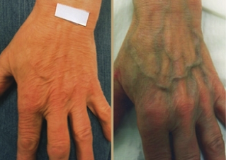 causes of varicose veins in the hands