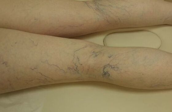 Varicose stars on the legs