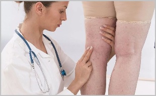 A woman consulted a doctor with clear signs of varicose veins