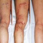 Varicose veins of the legs.
