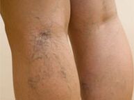 Varicose veins on the legs. 