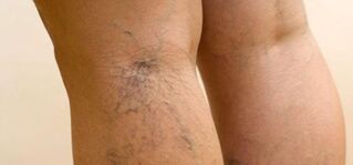 Varicose veins on the legs. 