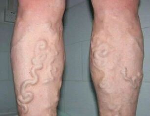 Grade 3 varicose veins on the legs. 