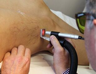 Contraindications to the treatment of varicose veins with laser. 