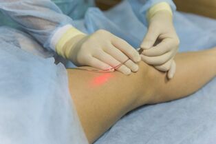 varicose vein laser treatment the essence of the procedure