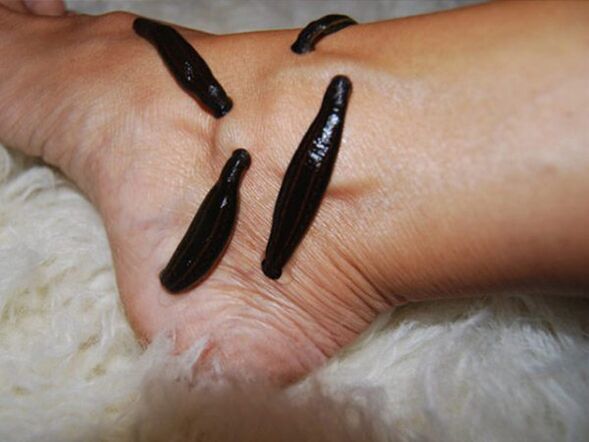 Treatment of varicose veins of the legs with leeches. 