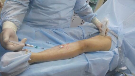 Surgery for varicose veins in the legs. 