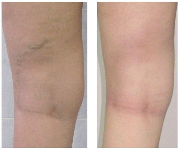 vein in the leg before and after varicose vein treatment