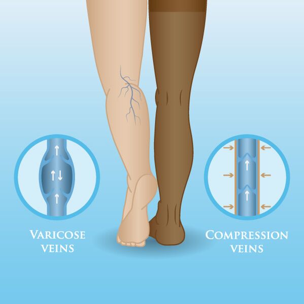 Effects of compression garments on varicose veins of the legs