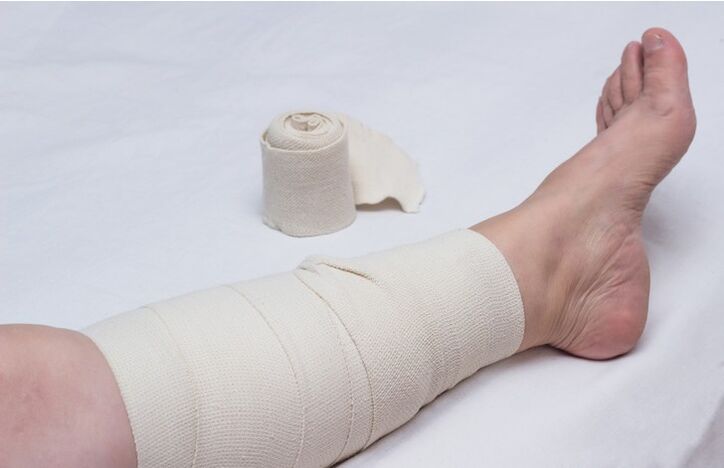 compression bandage on leg for varicose veins