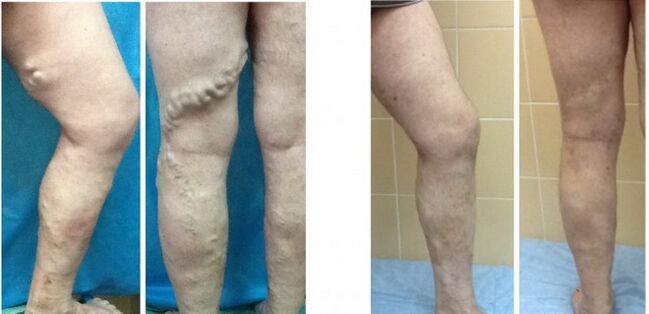 Legs before and after obliteration of veins with varicose veins by radiofrequency