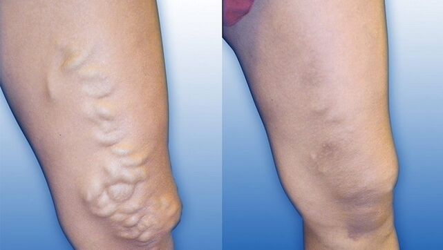 Legs before and after severe varicose vein treatment