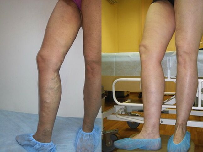 Legs before and after varicose vein laser treatment