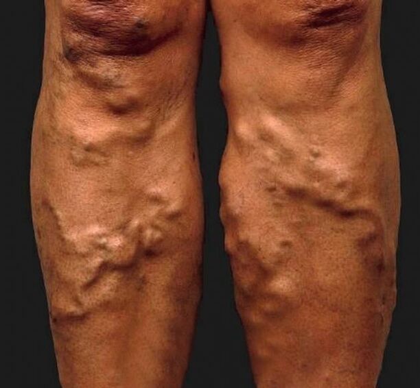 neglected varicose veins on the legs