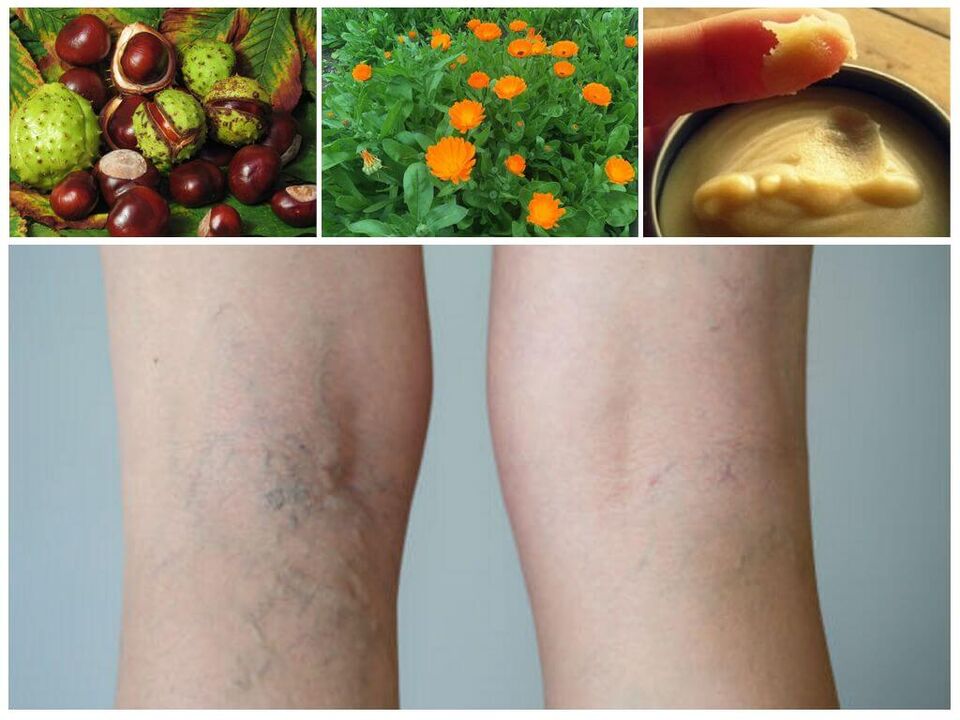 Varicose veins in the legs and home remedies for their prevention. 