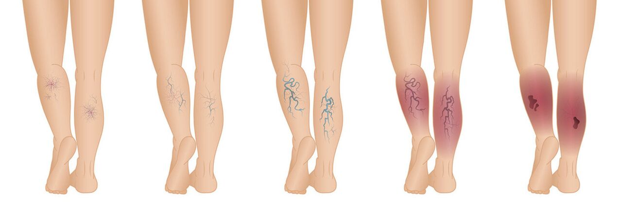 Stages of varicose veins of the lower extremities. 