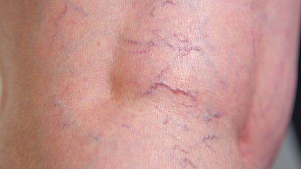 Signs of reticular varicose veins of the lower extremities fine vein dilation and vascular mesh