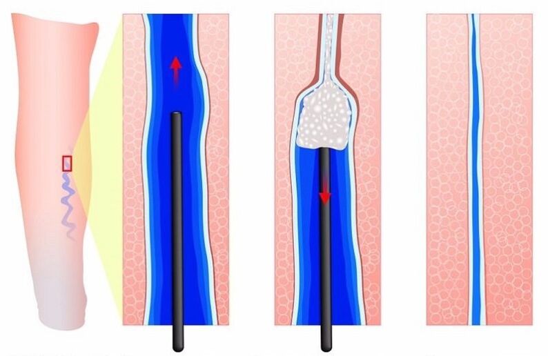 sclerotherapy for varicose veins in the legs in men