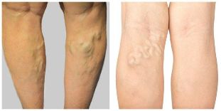 varicose veins of the veins in the legs