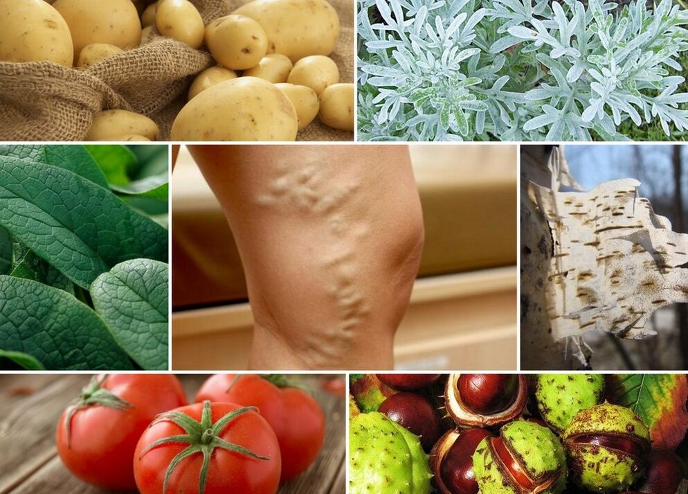home remedies for varicose veins