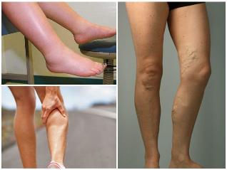 the consequences of varicose veins