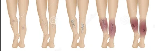 Varicose veins of the veins of the lower extremities - stage